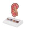 3B Scientific Kidney Stone Anatomy Model Anatomy Warehouse 3B Scientific Kidney Stone Anatomy Model Anatomy Warehouse