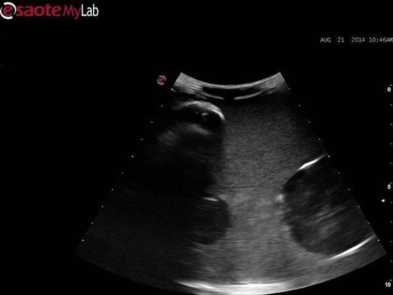 Blue Phantom Abscess Drainage Ultrasound Training Model