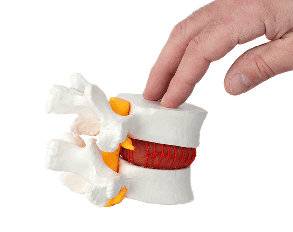 Axis Scientific Human Lumbar Herniating Disc Demonstration Anatomy Model - Animation of Hand Compressing Spinal Disk to Create a Hernia Bubble Axis Scientific Human Lumbar Herniating Disc Demonstration Anatomy Model - Animation of Hand Compressing Spinal Disk to Create a Hernia Bubble