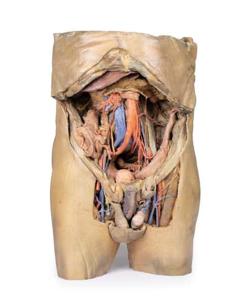 3D Printed Abdomen with Bilateral Hernias 3D Printed Abdomen with Bilateral Hernias