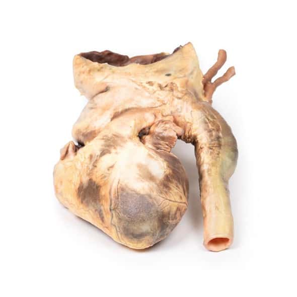 3D Printed Syphilitic Aneurysm 3D Printed Syphilitic Aneurysm