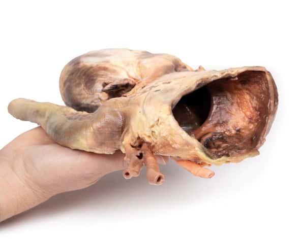 3D Printed Syphilitic Aneurysm 3D Printed Syphilitic Aneurysm 1
