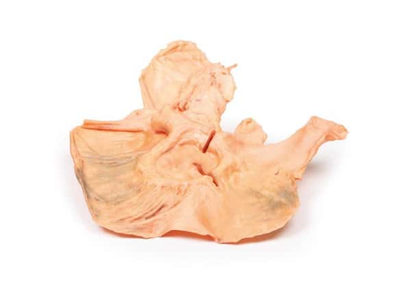 3D Printed Adenocarcinoma of the Stomach 3D Printed Adenocarcinoma of the Stomach