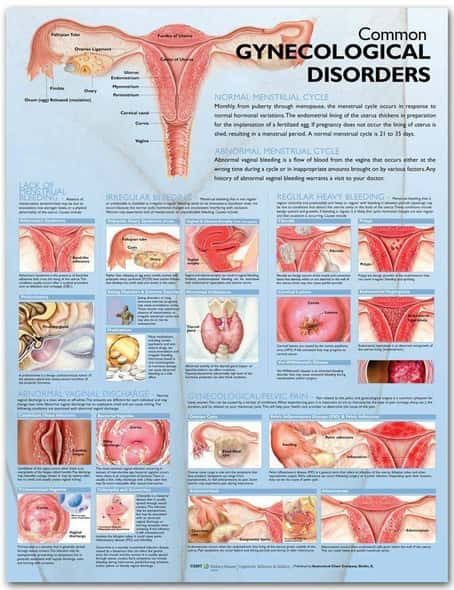 Common Gynecological Disorders Laminated Anatomical Chart Common Gynecological Disorders Laminated Anatomical Chart