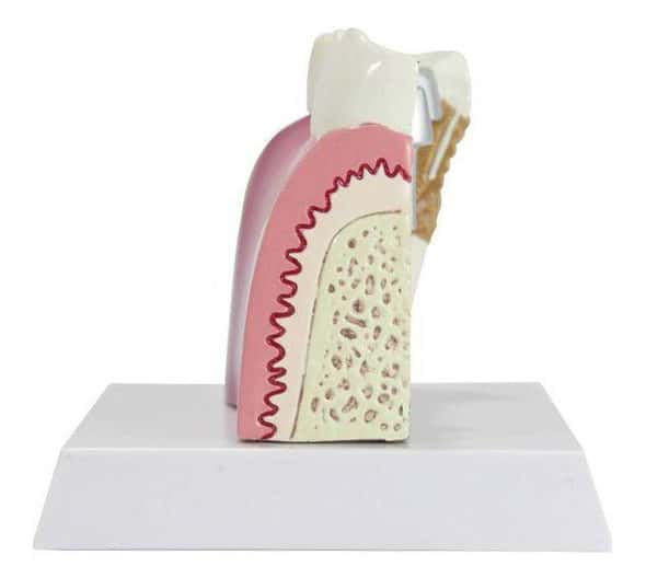Diseased Teeth and Gums Anatomy Model Diseased Teeth and Gums Anatomy Model 1