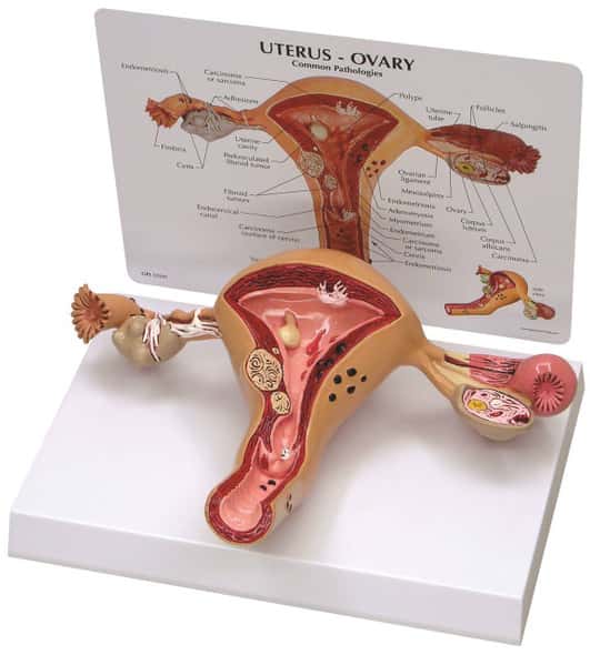 Uterus and Ovary Anatomy Model With Pathologies Uterus and Ovary Anatomy Model With Pathologies