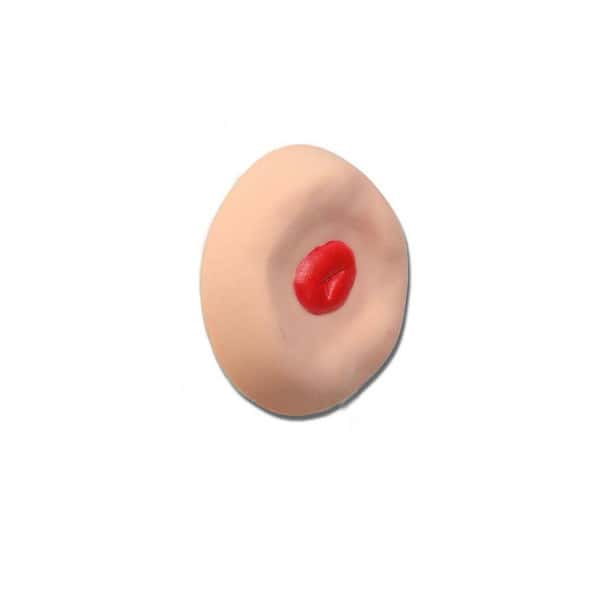 Recessed Stoma Recessed Stoma