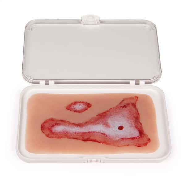 Skin Moulage, Scalding Wound