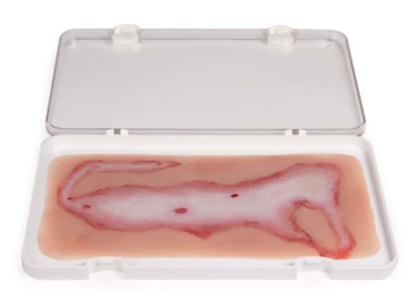 Skin Moulage, Large Scalding Wound