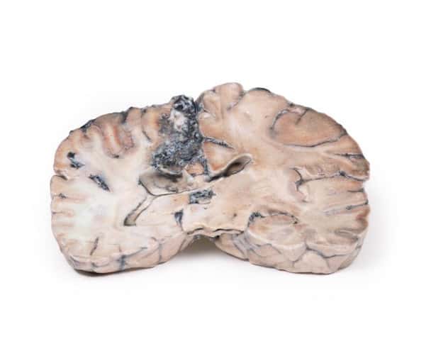 3D Printed Cerebral Arterio-Venous Malformation