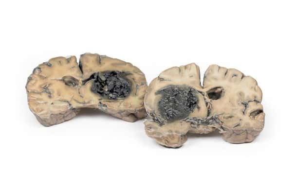 3D Printed Intracerebral Haemorrhage
