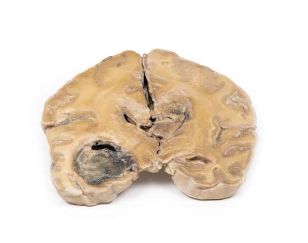 3D Printed Glioblastoma Multiforme in Left Temporal Lobe