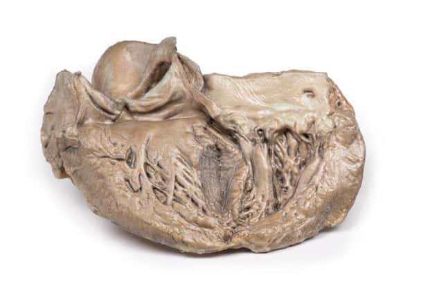 3D Printed Bicuspid Aortic Valve