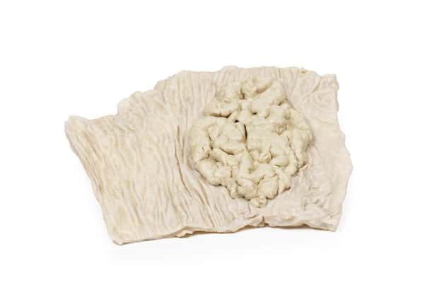 3D Printed Villous Adenoma of Colon