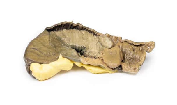 3D Printed Intussusception of Small Bowel Due to Metastatic Tumour