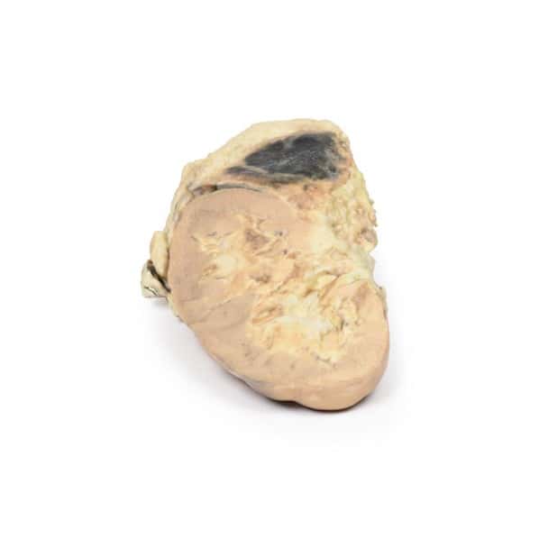3D Printed Adrenal Haemorrhage with Waterhouse-Friderichsen Syndrome