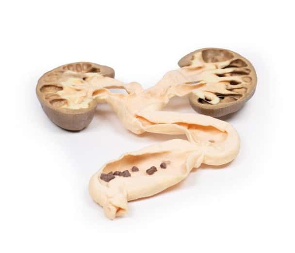 3D Printed Hydronephrosis Hydroureter