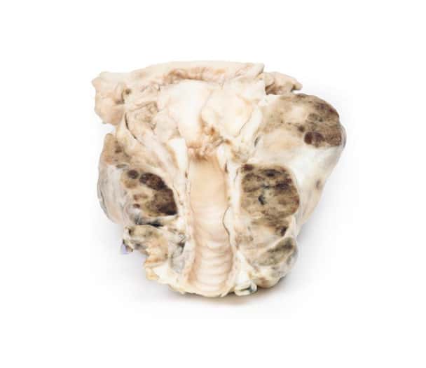 3D Printed Multinodular Goiter