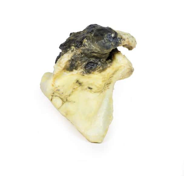 3D Printed Chondrosarcoma of Scapula