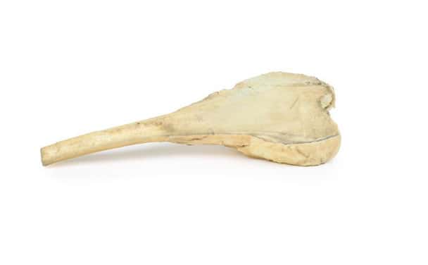 3D Printed Osteosarcoma of the Distal Femur