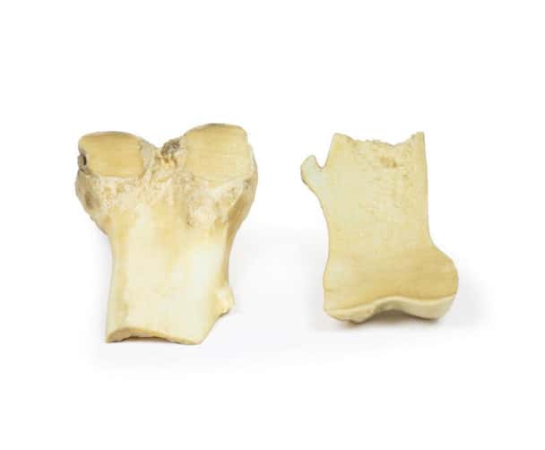 3D Printed Osteochondroma