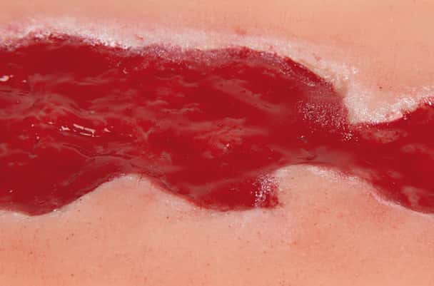 Wound Moulage Venous Leg Ulcer, Small, Granulation Phase