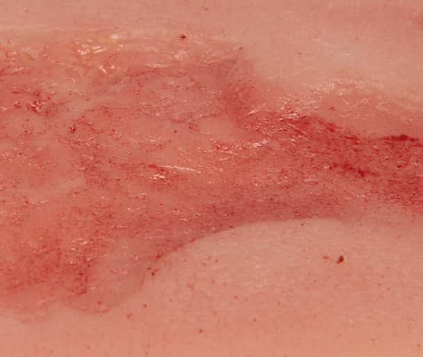Wound Moulage Venous Leg Ulcer, Small, Epithelisation Phase