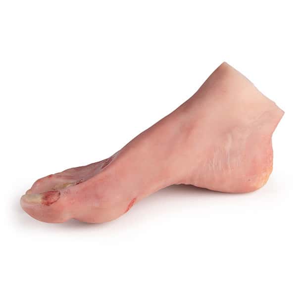 Wound Foot with Diabetic Foot Syndrome, Severe Stage