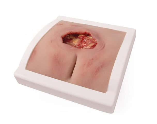 Wound Moulage Sacral Decubitus, Cleaned Including Stand