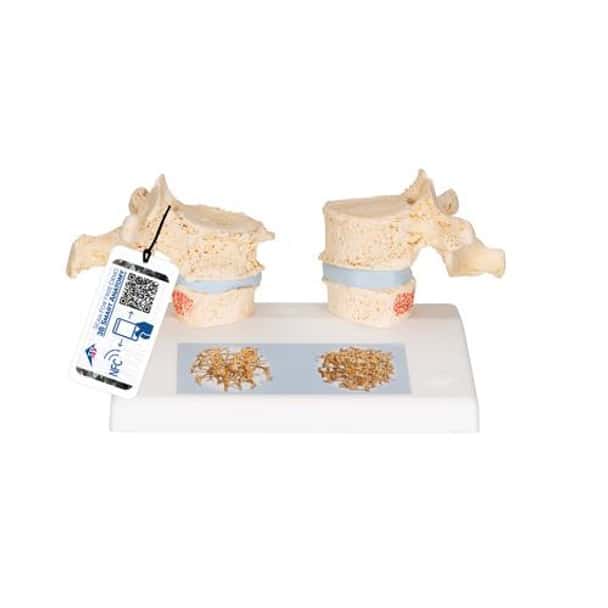 Osteoporosis Anatomy Model
