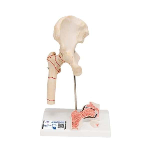 Femoral Fracture Anatomy Model