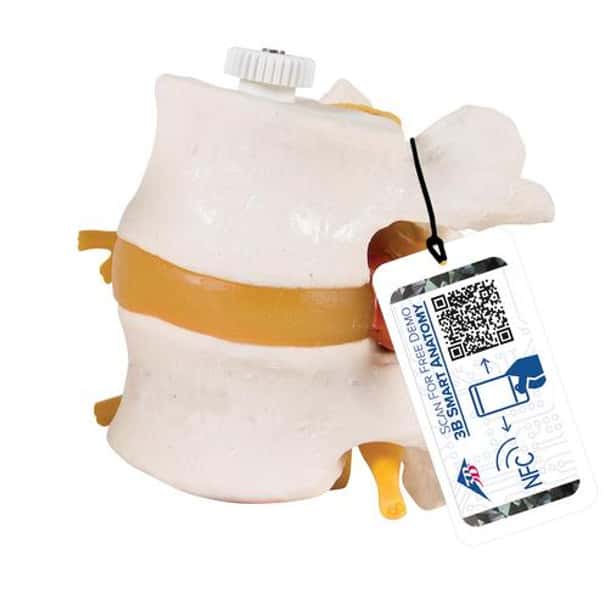 2 Lumbar Vertebrae Anatomy Model With Prolapsed Disc