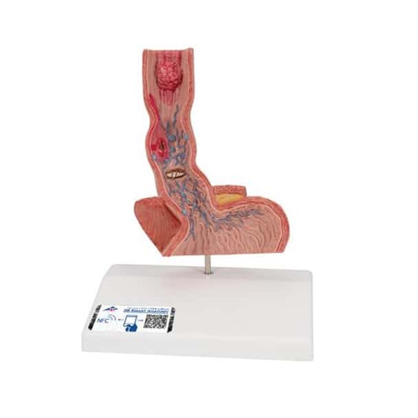 Illnesses Of The Esophagus Anatomy Model