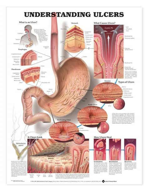 Understanding Ulcers Laminated Anatomical Chart