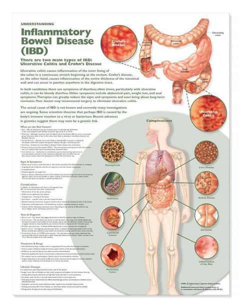 Inflammatory Bowel Disease IBD Laminated Anatomical Chart
