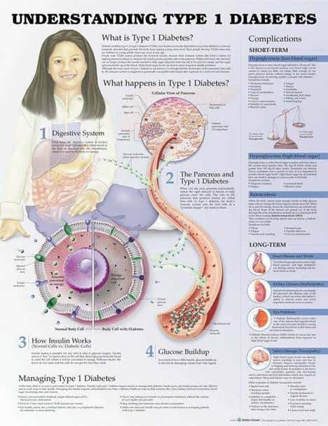 Understanding Type 1 Diabetes Laminated Anatomical Chart - 3rd Edition
