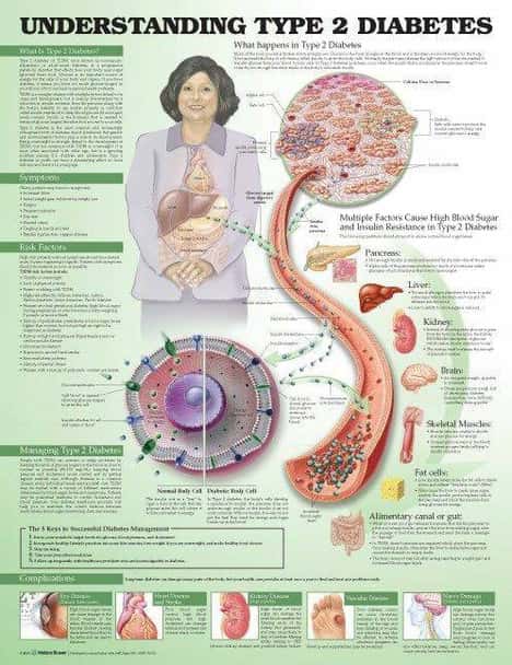 Understanding Type 2 Diabetes Laminated Anatomical Chart 3rd Edition