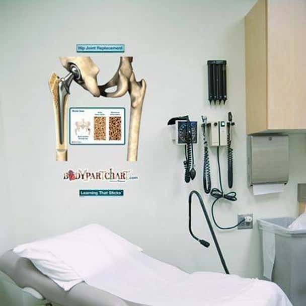 Hip Replacement Anatomy Dry-Erase Sticky Wall Chart - 27 in x 40 in