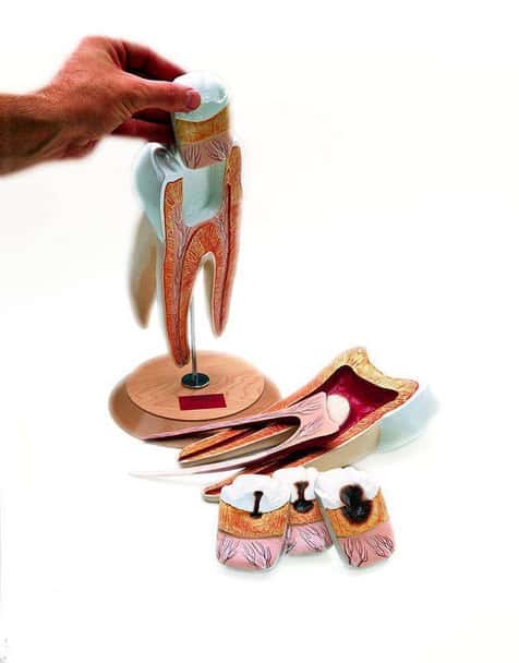 Giant Three Root Molar Anatomy Model