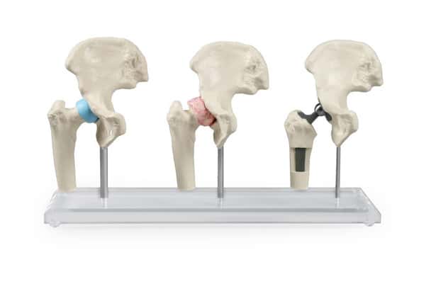 Hip Implant Model