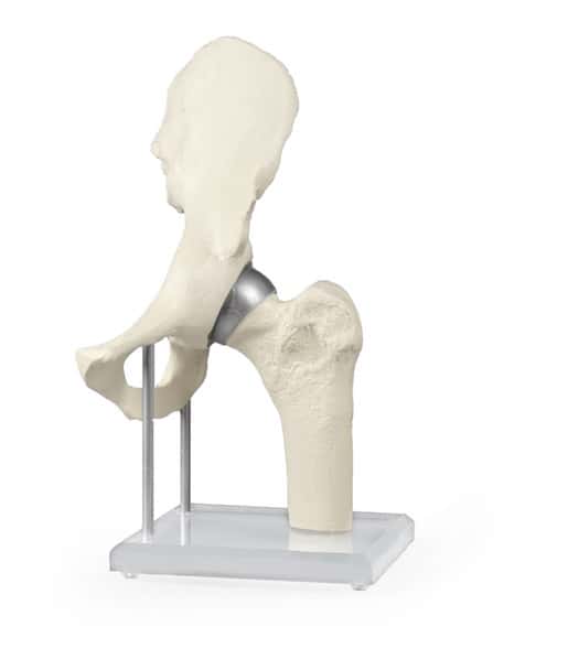 Hip Joint with Resurfacing Implant