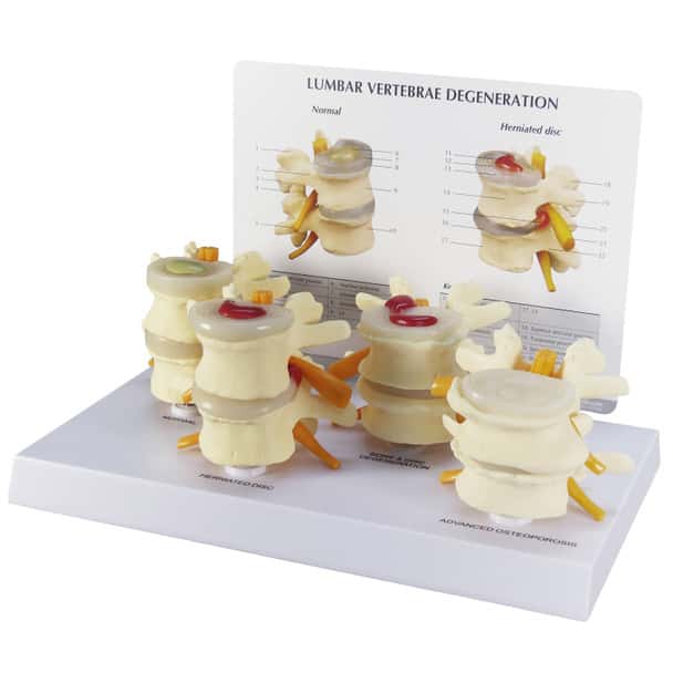 Four Stage Vertebrae Set Anatomy Model