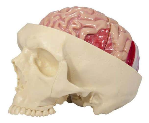 Diseased Brain In Skull Anatomy Model
