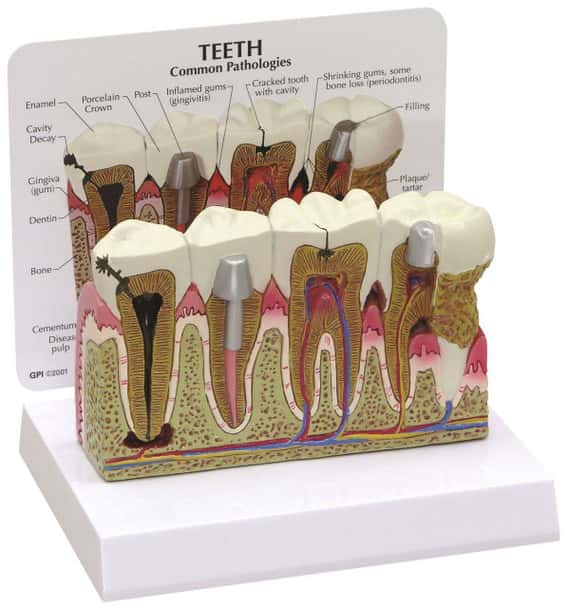 Diseased Teeth and Gums Anatomy Model