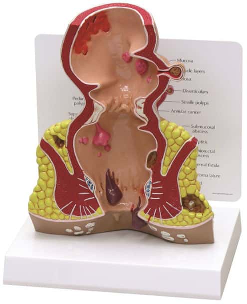 Rectum Anatomy Model With Pathologies