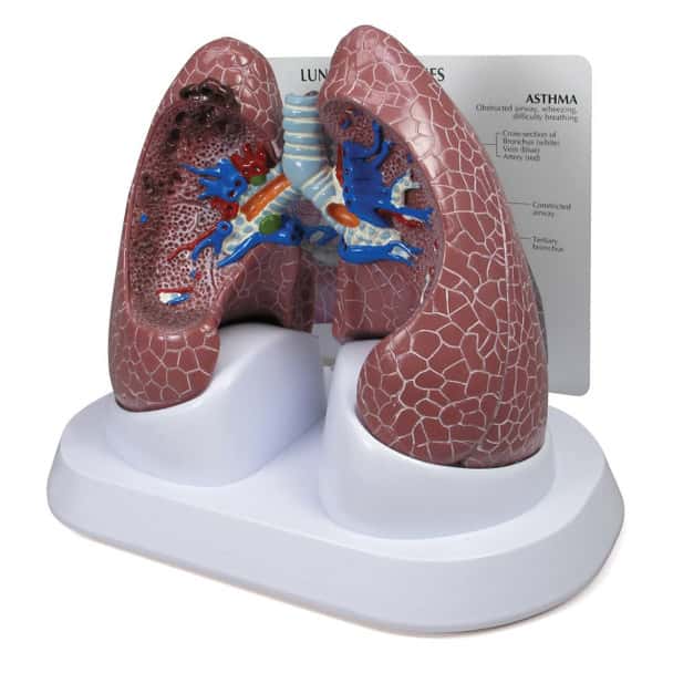 Diseased Lung Anatomy Model