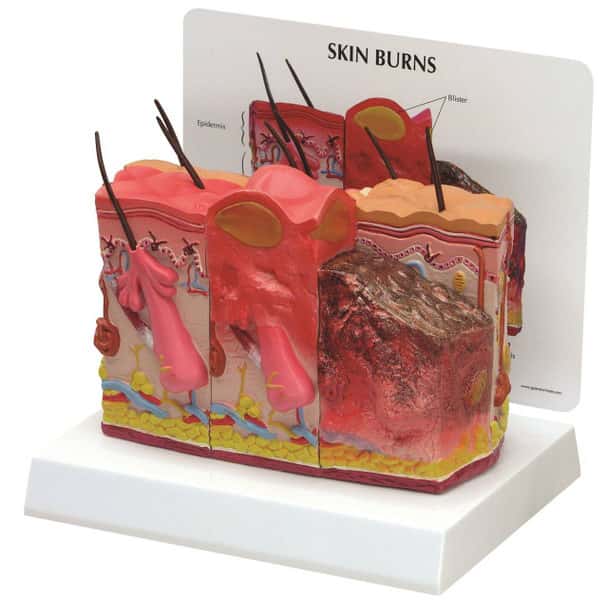 Skin Burn and Normal Skin Anatomy Model