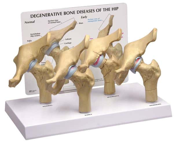 4-Stage Arthritic Hip Anatomy Model