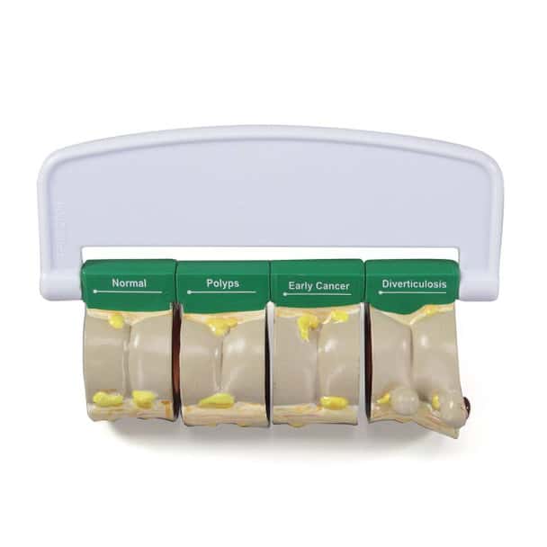 4-Piece Colon With Pathologies Anatomy Model