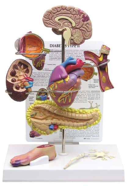 Type 2 Diabetes Anatomy Model
